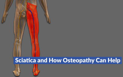 Osteopath for Sciatica Pain and How Osteopathy Can Help